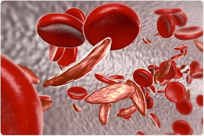 Sickle Cell Disease Treatment